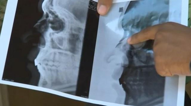 Raio X mostra paciente com nariz quebrado (Foto: Reprodução/TV TEM)