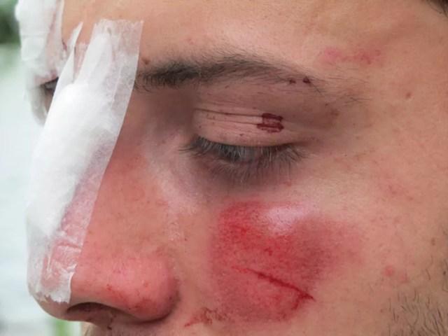 Estudante Luís com o rosto machucado em 2010 após agressão com lâmpada — Foto: Leticia Macedo/G1