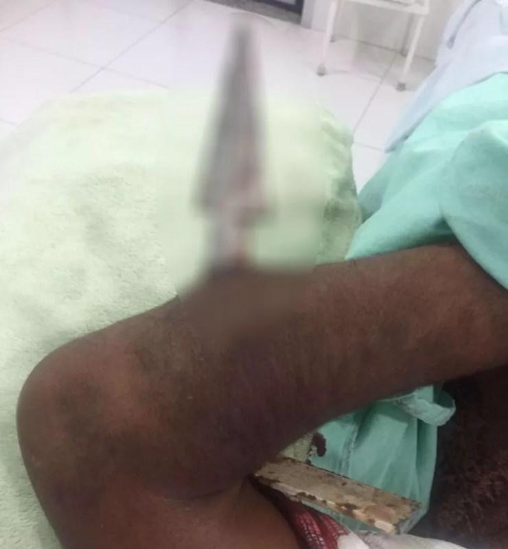 A lança de ferro atravessou totalmente o antebraço do garoto de 16 anos (Foto: Divulgação / Corpo de Bombeiros)