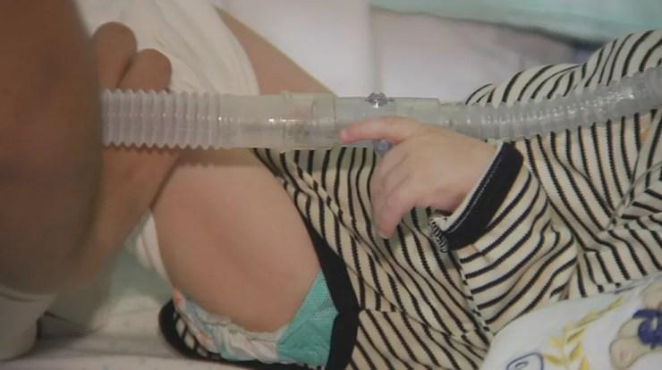 Bebê diagnosticado com AME usa respirador e se alimenta por uma sonda naso-enteral (Foto: Reprodução/TV TEM)