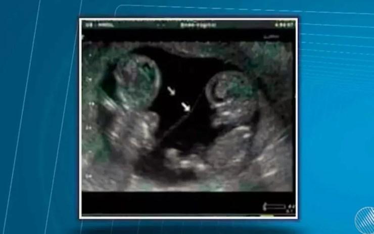 Último ultrassom de Cleidiane mostra dois fetos (Foto: Reprodução/TV Santa Cruz)