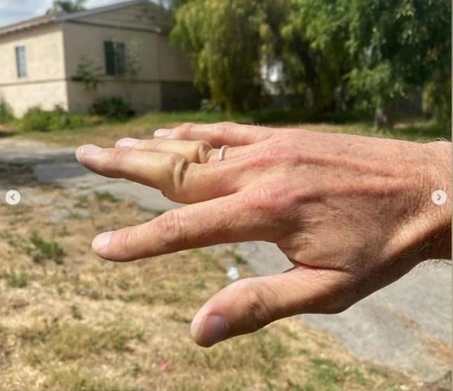 Tony Hawk mostra a mão deslocada após acidente de skate — Foto: Reprodução/Instagram