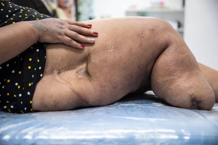 Além da perna amputada, Joseane ficou com uma cicatriz profunda que sobe pela lateral do corpo e outras espalhadas devido ao atropelamento por um trem — Foto: Fábio Tito/g1