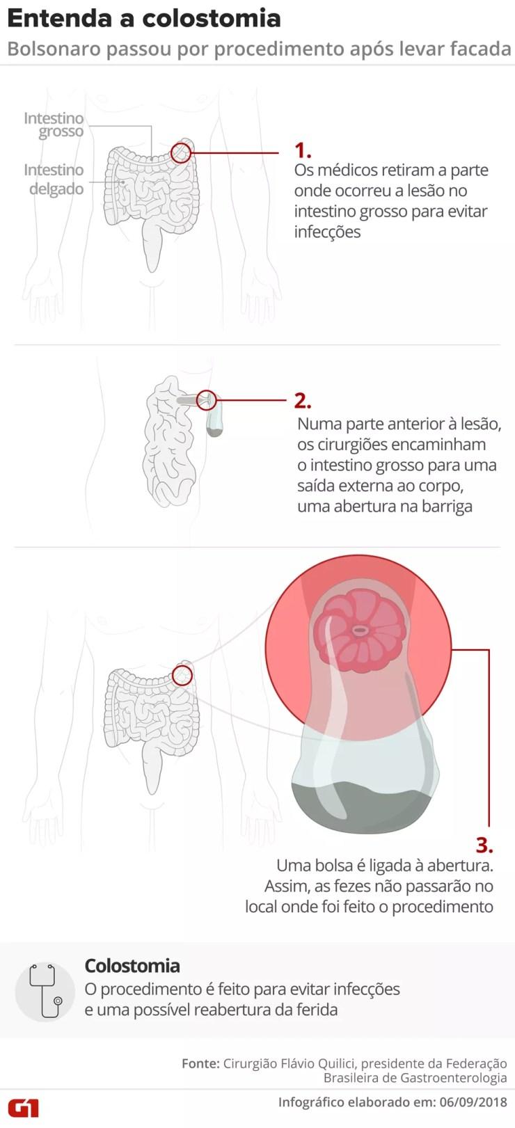 Colostomia: entenda o procedimento pelo qual passou Bolsonaro — Foto: Igor Estrella e Alexandre Mauro/G1