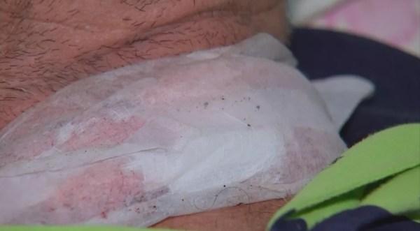 Corte no pescoço do motociclista atingido por cerol (Foto: Reprodução/TV TEM)
