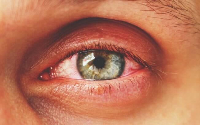 Olhos de paciente com conjuntivite
