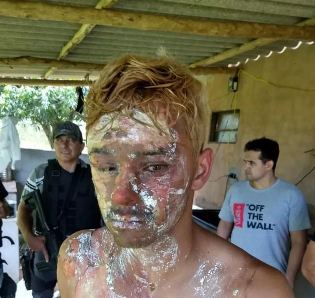 Ex ficou com o rosto queimado após ser atingido com água quente  — Foto: Polícia Civil/Divulgação 